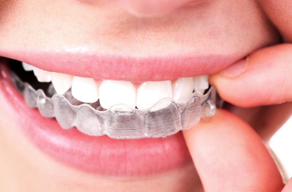 clinica dental parla invisalign ortodoncia invisible