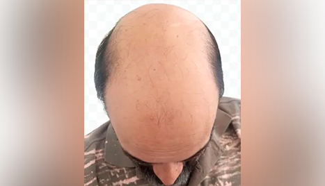 alopecia_g7